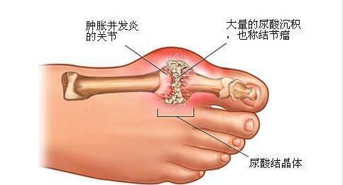 秋冬季節(jié)小心痛風，在飲食方面該注意些什么？