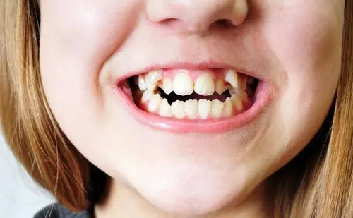 孩子經(jīng)常用舌頭舔牙齒會改變牙齒形狀嗎？