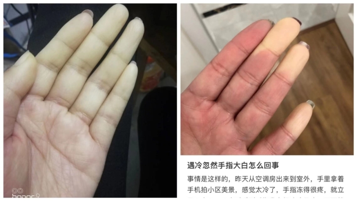天氣一冷手指就發(fā)白僵硬 原來是一種極易被忽視的??！有人險(xiǎn)些被截肢