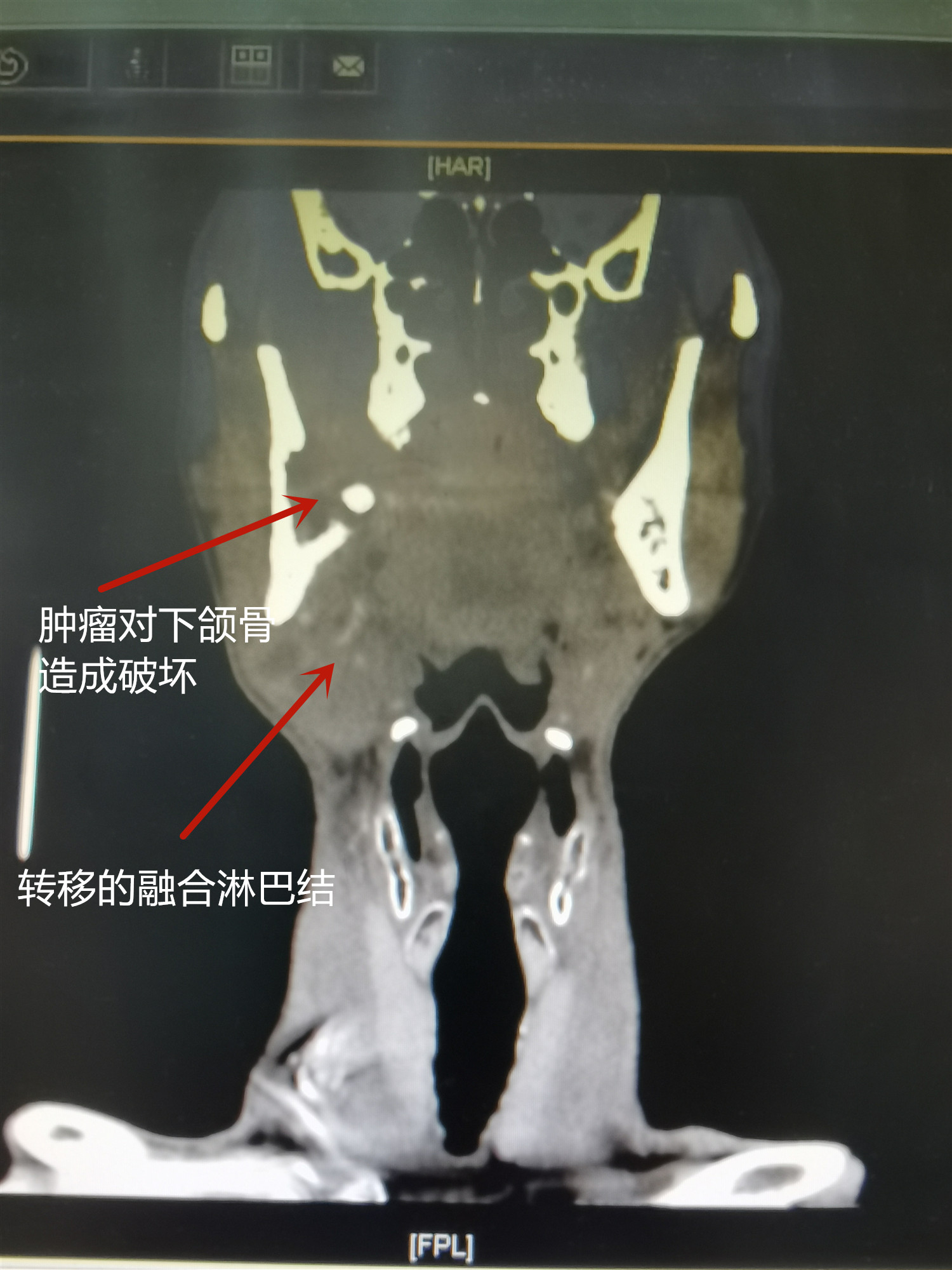 吃藥也不管用？警惕遷延不治的牙疼“成為”口腔癌