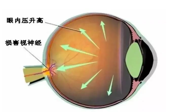 致盲率極高，青光眼呈現(xiàn)年輕化趨勢