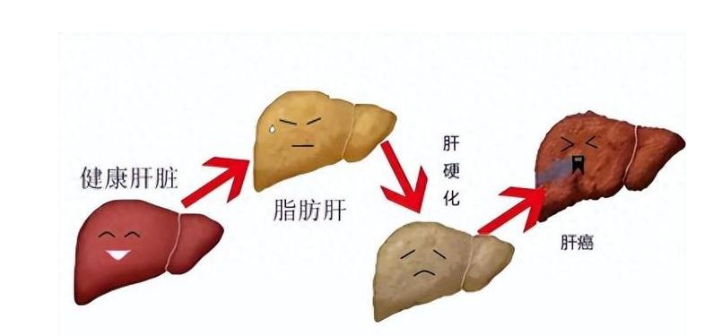 脂肪肝是否需要治療 肝病科醫(yī)生為您一次說(shuō)清