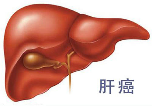 為什么肝癌早期難以發(fā)現(xiàn)？